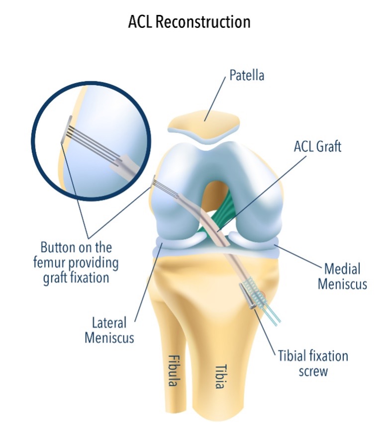 A Diagram showing the grafting process for the ACL surgery.
